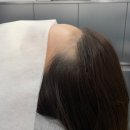 무수(MOOSOO) | 강남smp 헤어라인 커버 후기 : 무수청담