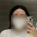 3 | [내돈내산] 이마축소 수술 3개월 후기 낋여왔어욤