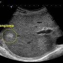 hemangioma sono 이미지