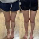 대전하프의원 | 대전 비만클리닉의원 지방분해주사 추천 하프한 몸매 감량 후기