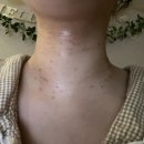 부산 정관 쥐젖제거 리뷰티 후기