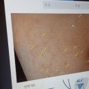 재이앤파크호텔(동대문) | [동대문 여드름 압출] '앤올리브에스테틱 동대문본점'에서 여드름 관리 후기