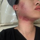 호산사우나 | 여름방학 맞이 리프팅 시술 압구정피부 인어젯 (인모드+에어젯) 후기