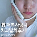 굿모닝약국 | [내도내산] 평택 굿모닝병원 치과 매복사랑니 발치 비용 붓기 식사 주의사항 등 자세한 후기!!