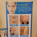 [파주 운정 피부관리] 와이제이뷰티 - 여드름, 흉터, 기미 제거 솔직후기 &#39;콜드플라즈마&#39; 추천