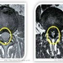 [허리디스크/척추관협착증]허리디스크와 척추관협착증의 증상.치료.질환 비교 이미지