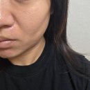 정릉2 | 정릉피부과 땅콩페이스 쥬브겔 후기 2