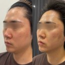 대구 여드름흉터 모공 리프팅 한번에 시크릿셀 아미뷰티