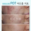 리더스힐링캠프 | PDT 효과 여드름 완전정복 !