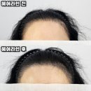 이마라인 정리만 했는데 이렇게 달라져요?[옥길동헤어라인/소사헤어라인/범박동헤어라인 ]