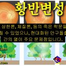 안구돌출증 치료 - 사암오행침, 사암침법, 오행침, 정통사암침 이미지