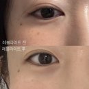 부산피부과 레블라이트SI 레이저토닝 후기 눈가 기미 고민될때