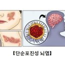 단순포진성 뇌염(Herpes simplex encephalitis) 이미지