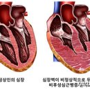 "'비후성 심근증' 환자, 심장 수축 정상이어도 예후 나쁠 수 있어" 이미지