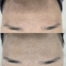 거제에스테틱 킴스뷰티 윤곽관리 비립종제거 후기