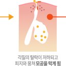 여드름 생기는 이유 왜 나타나는지 살펴봐요! 이미지