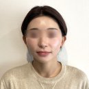 굿모닝플러스외과의원 | 신사역성형외과, 리프팅 잘하는곳 후기만 보고 가면 될까? 시술 전 확인할 점