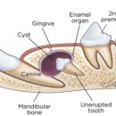 파란동물병원 | 강아지 잇몸 부음? 잇몸 종괴? 강아지도 매복치가 있어요! - 발치 후기/치과전문동물병원