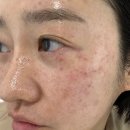 별내중앙약국 | 남양주 별내피부과 노블린레이저 기미치료후기