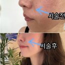 [뷰티]울쎄라피 프라임 한달차 후기 (강남역 피부과)