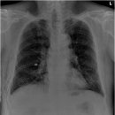 기흉(pneumothorax) 이미지