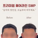 4224 | 👉공주 신탄진 두피문신 “지금 안 하면 더 넓어집니다 (헤어라인 실제 변화)”