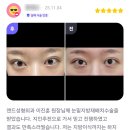 지인성형외과의원 | 지인추천 받은 앤드성형외과 눈밑지방재배치 수술 후기
