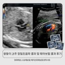 28140-8-1-21 | 쌍둥이21주정밀초음파 결과, 신우 4.1mm로 태아보험 거절사유 후기
