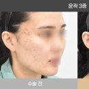 리스펙성형외과의원 | 붓기적은 윤곽3종(사각턱, 광대축소, 턱끝축소) - 리스펙성형외과 김기웅원장의 윤곽이야기