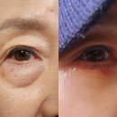 눈밑쳐짐. 눈밑지방 제거/ 완벽한 그녀에게 말 못할 고민 쌉 해결 찐후기