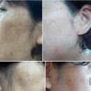 H뷰티(H beauty) | 부산플라즈마 H뷰티엠 얼굴전체 1회후기 효도잡티제거