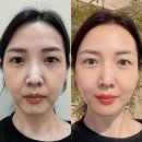 울쎄라가 필수! 새로 나온 울쎄라2 울쎄라피프라임 400샷 내돈내산 시술 후기 | 울세라 효과, 부작용