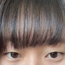 [후기] #3 홍대 퀵매몰 쌍수 (한 달 솔직후기)
