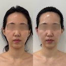 모란피부관리ㅣ에스테틱유 무통증 윤곽관리 3V테라피 만족후기 (건물무료주차)