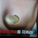 유방암 치료 혁명 보존하고 완치한다 이미지