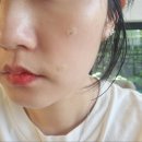 온더아셀 | 선정릉 피부과에서 슬로우에이징 추구하며 쥬브아셀V 받은 솔직후기, 피부결 변화 기록