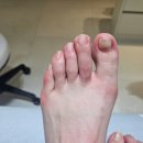 엔케이메디칼 | 아산네일 탕정 엔케어센터 내성발톱 교정후기