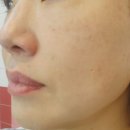 인치바이인치_LPG엔더몰로지 인천부평점 | 홍조피부 건강하게 만드는 부평피부관리 인치바이인치_LPG엔더몰로지 인천부평점에서 플라즈마 홍조관리...