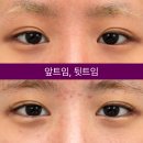 아이케이성형외과의원 네이버블로그