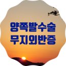 [공지] 양측 발 무지외반증 수술한 후기