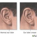 귓볼주름, 귀주름, 치매 뇌졸중 위험! 이미지
