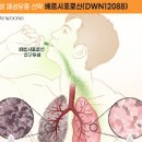 폐섬유화로 알아볼 수 있는 간질성폐질환 원인과 증상 이미지