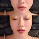 이연스킨케어 | 김포 피부관리 추천, 이연에스테틱 올리지업 2000샷리프팅 얼굴라인이 달라진 후기