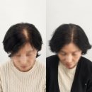 분당 판교탈모커버 [모이스SMP] 여자 가르마 솔직후기
