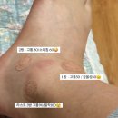 거제 정형외과 발목염좌치료 프롤로주사 4회차 아킬레스건 통증 후기