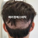 ㈜희망을심는나무 | 제주 공항근처 모발이식만이 답일까요? 나모나생장관리로 수백만원 아끼는 방법!!