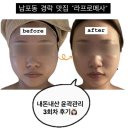 흑교로 | 남포동 경락 “라프로메사” 내돈내산 얼굴 윤곽 관리 6회차 비포 애프터 후기