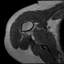 골연골종증(osteochondromatosis) . 이미지