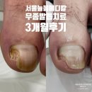 미소메디칼내과의원 | [발톱무좀 3개월] 서울늘봄메디칼내과의원 무좀치료후기 구로 구로역 주블리아 오니코레이저 네일라카...