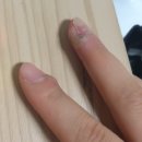 율무네 | 조갑하(손가락)사마귀 완치 후기 / 엔드와츠 / 냉동치료 / 베루말 / 율무